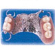 コバルトクロム義歯部分