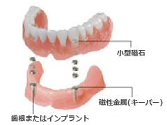 入れ歯治療メニュー