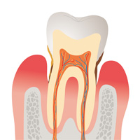 歯周病とは？