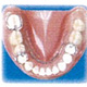 プラスチック義歯部分